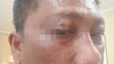 Wartawan PJS DPC Toba Dianiaya, Saat Liput Galian C Diduga Ilegal